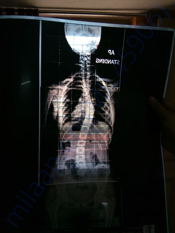 Scan Image of Spinal Cord.
