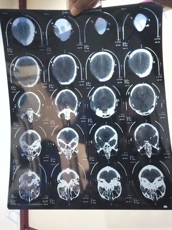CT scan after operation