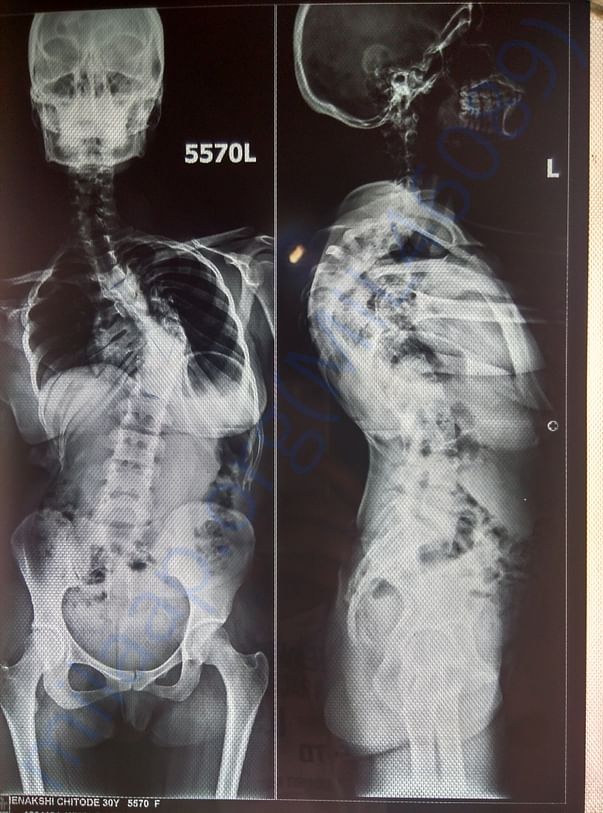 x-ray