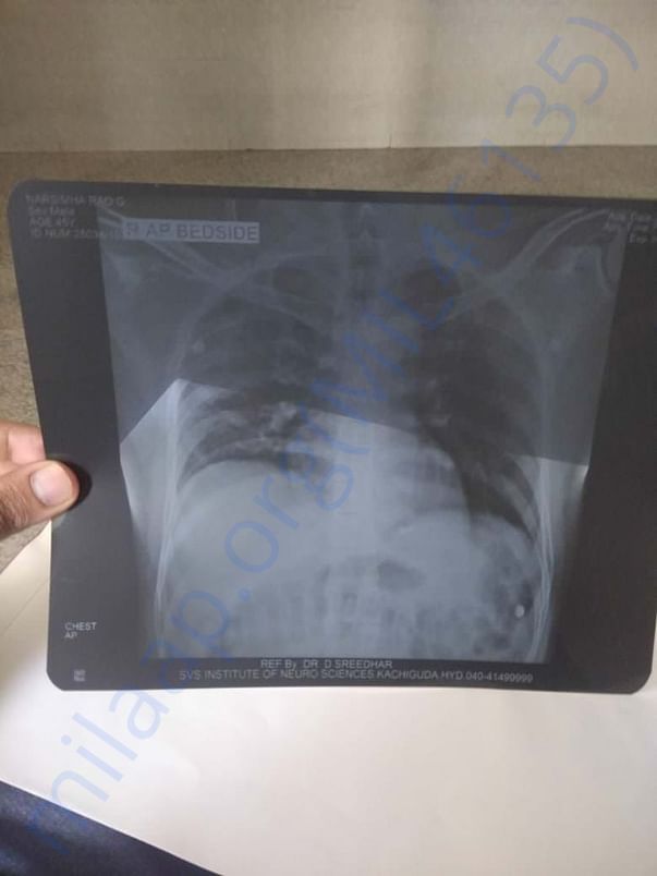 X ray