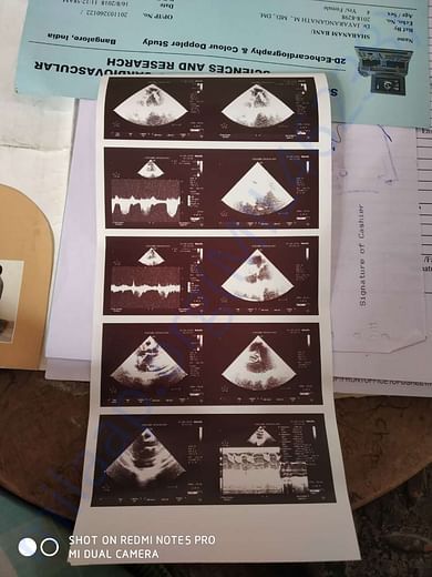 Echo cardiography and Doppler study