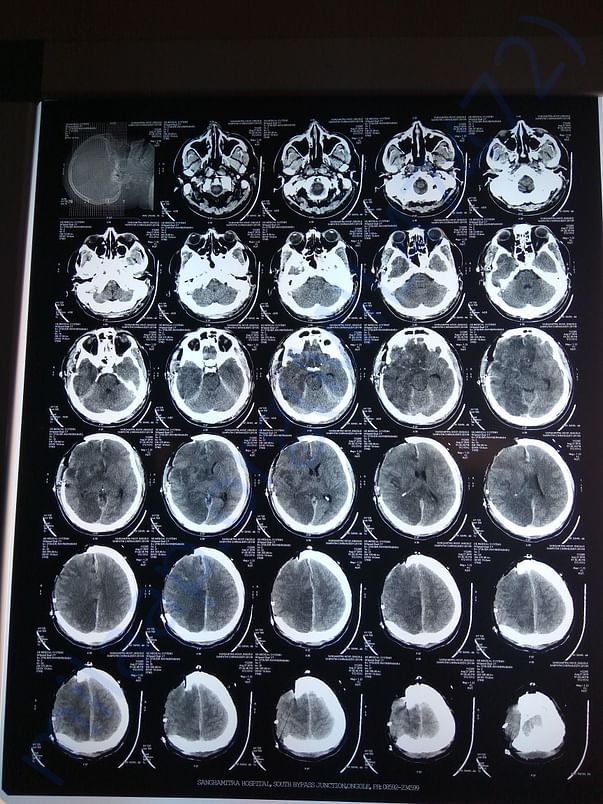 Brain