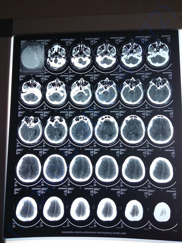 Brain