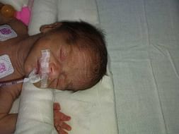 Seeking Financial Help for the Care of New-Born Twins in NICU