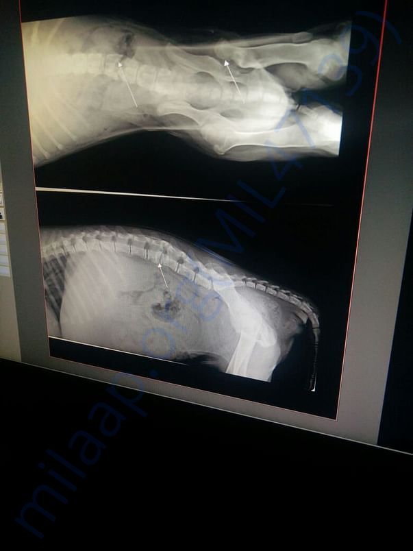 x-ray of Kambli's spine. arrows point to spinal damage.