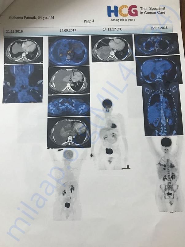 PET Scan 4 After 6 Chemo Sessions