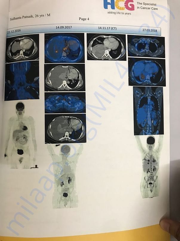PET Scan 4 Before Chemo Session
