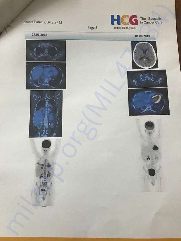 PET Scan 5 After 6 Chemo Sessions