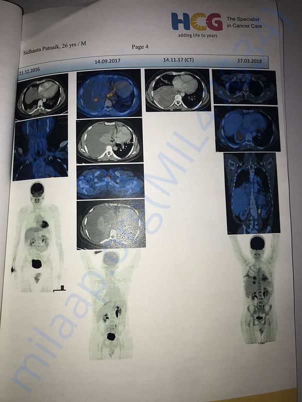 PET Scan 5 Before Chemo Sessions