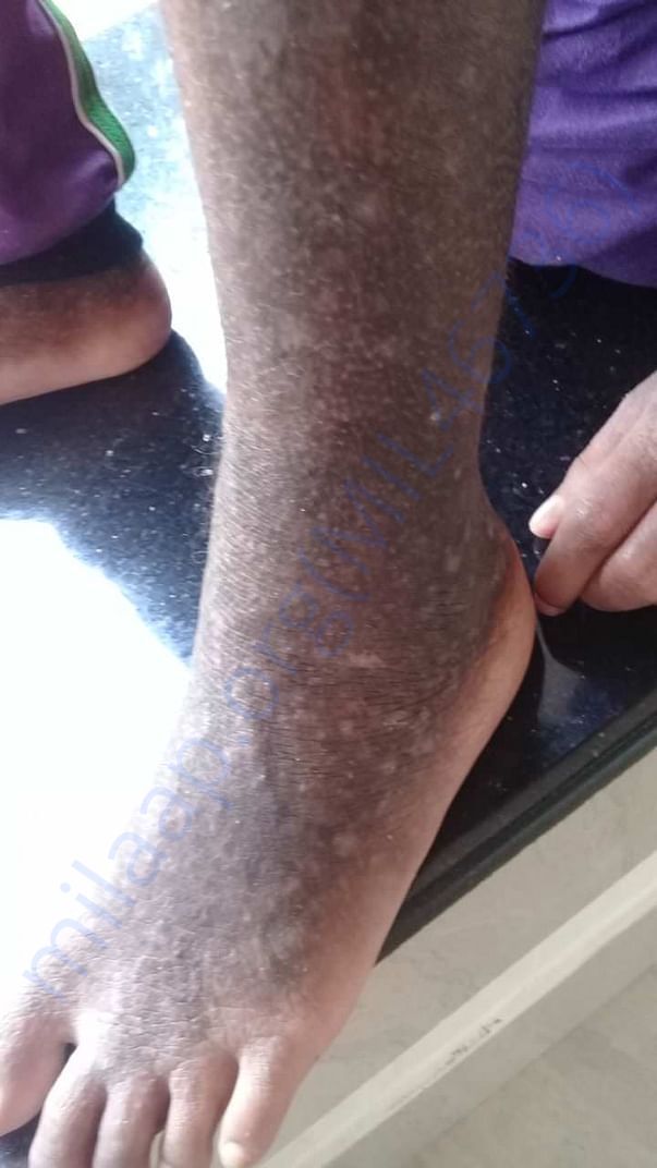 his leg is wounded by strong itching, whole body will be like this