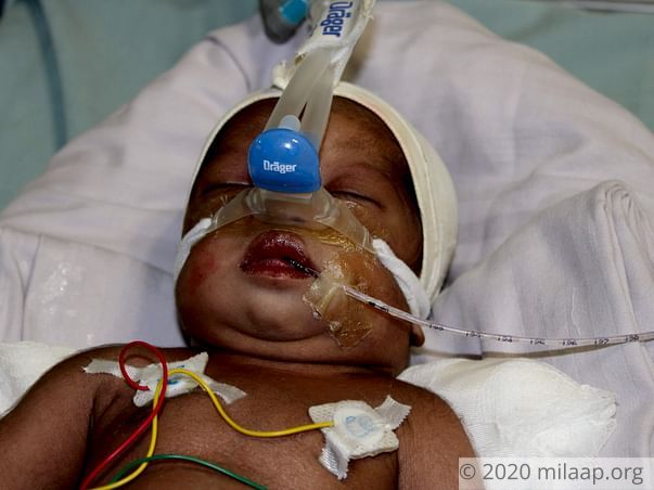 10-Day-Old Baby With A Damaged Brain And Failing Heart Needs Help