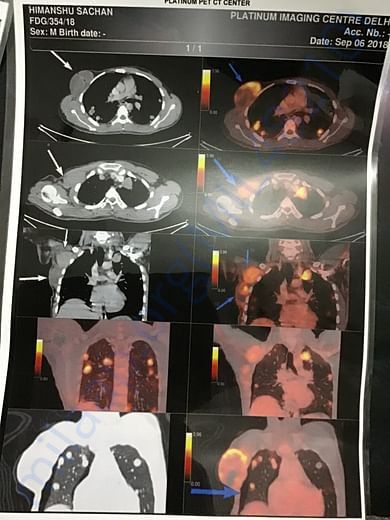 Petct scan