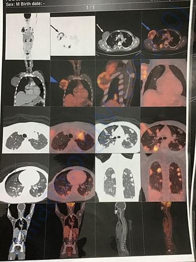 Pet ct 2