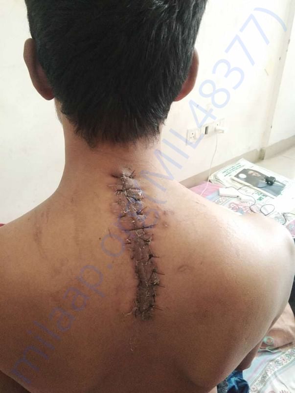 Surgery done on Raju's backbone