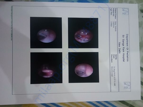 Subglottic stenosis