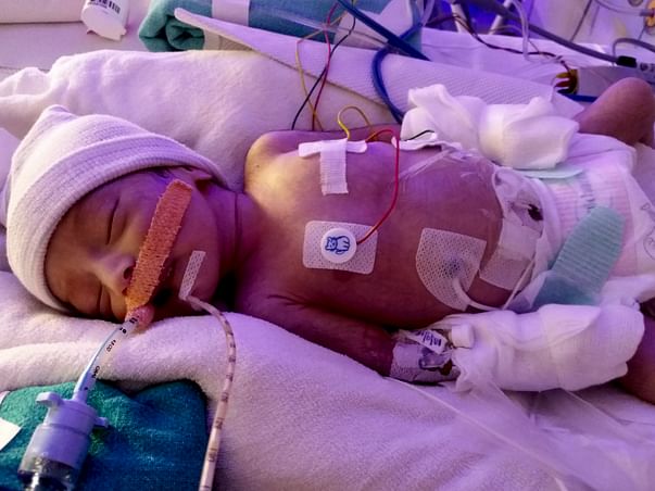 Help My Newborn Baby Girl Fight Congenital Heart Defect - HLHS