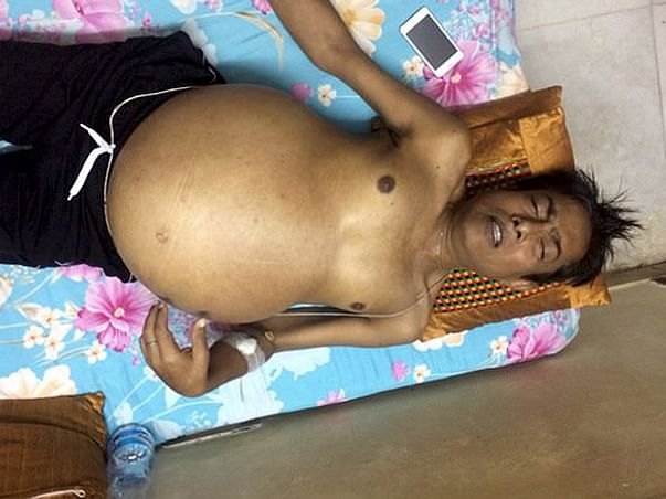 Help My Father Undergo Liver Transplant