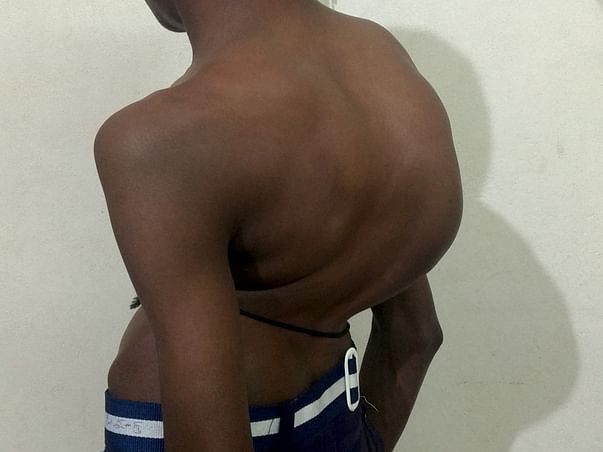 Help Shivakumar Recover from Spinal Cord Disorder
