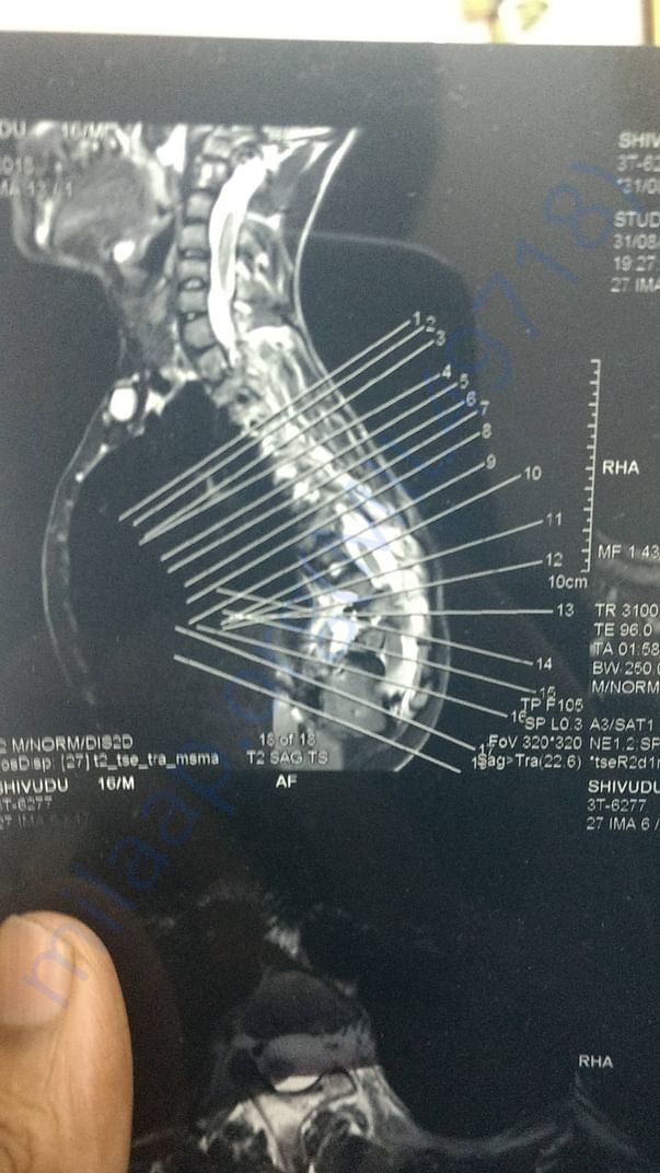 MRI Scan