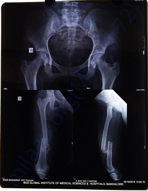 X ray of right leg