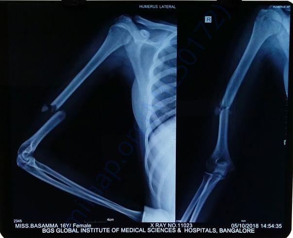 X ray of right hand