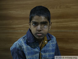 Prince lost his eye to cancer, need help for treatment