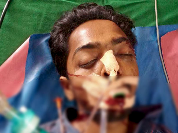 Help My Friend Recover from Temporal EDH with Femur Fracture