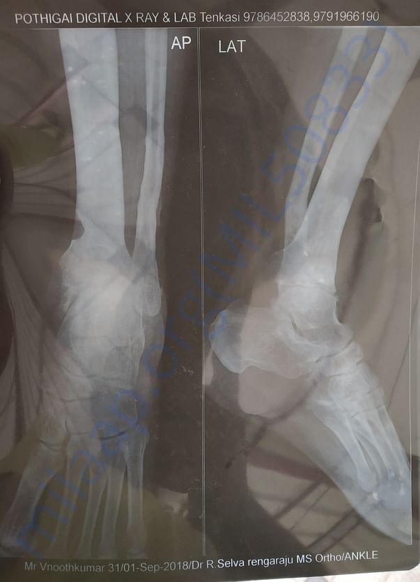 Leg bone broke and surgery will be done for ball joint .