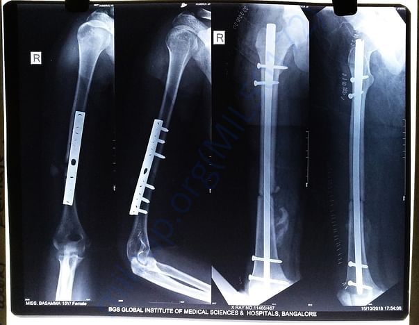 X Ray after operations
