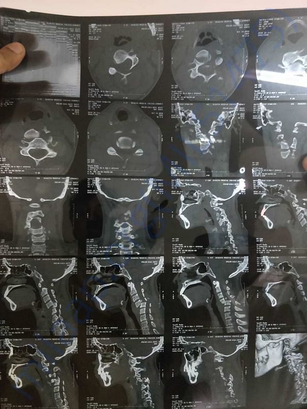 X-ray spine