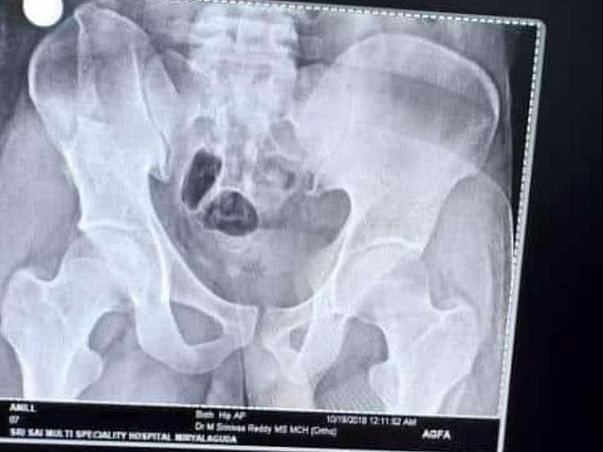 Help anil to survive from the accident