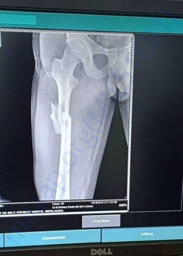 Fractures