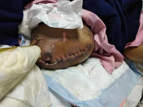 Amputed Leg