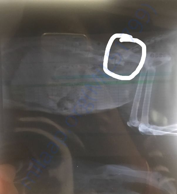 X-ray (Broken Spine)