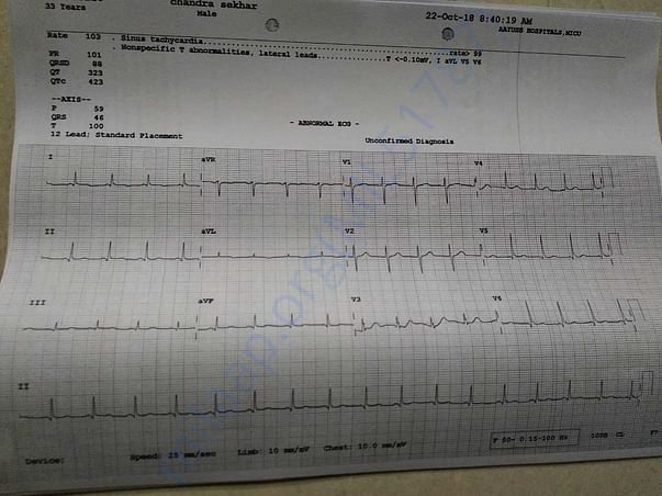 ECG
