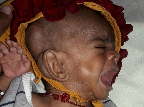 Help 4-month-old Baby Suffering From Hydrocephalus