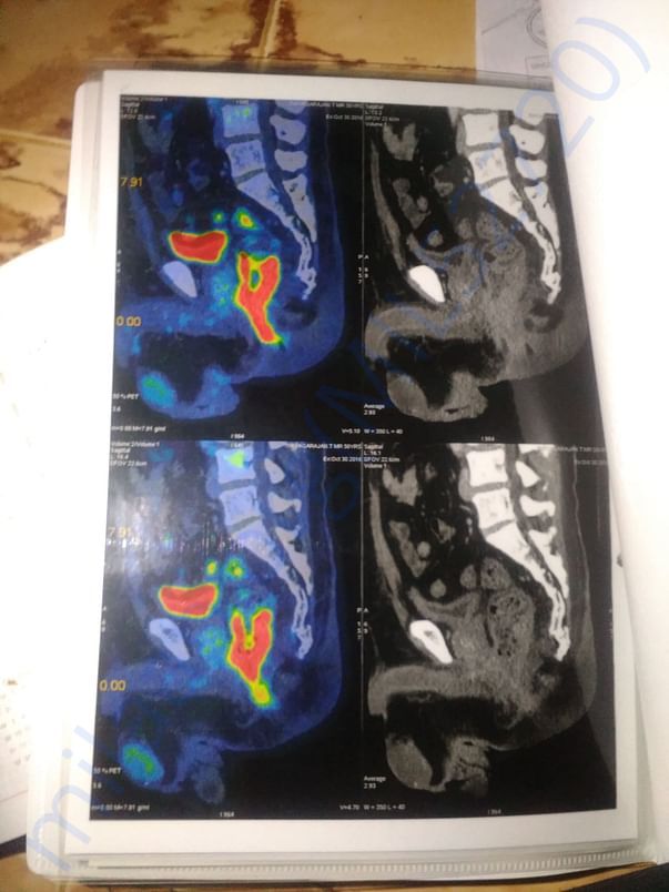 Pet scan image where it is located