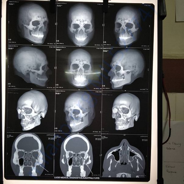 x ray 2