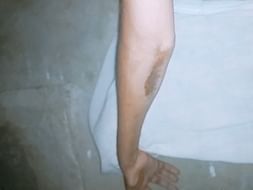 Help Bhimesh for struggling Rod Fixed In Right Hand Elbow