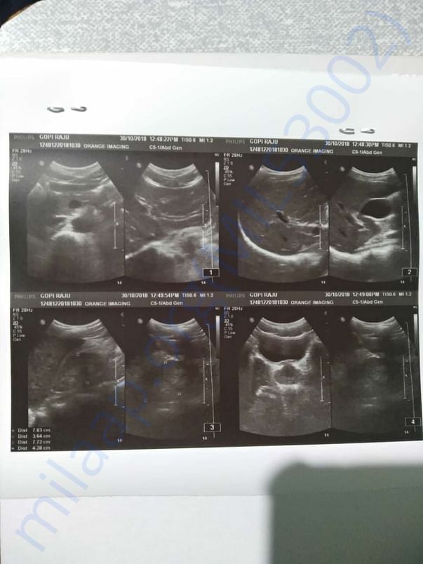 Kidney's x-ray