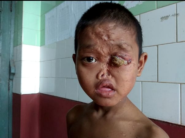 Help Niublusan Fight Against Severe Congenital Syphilis