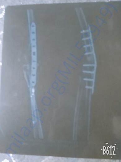 X-ray