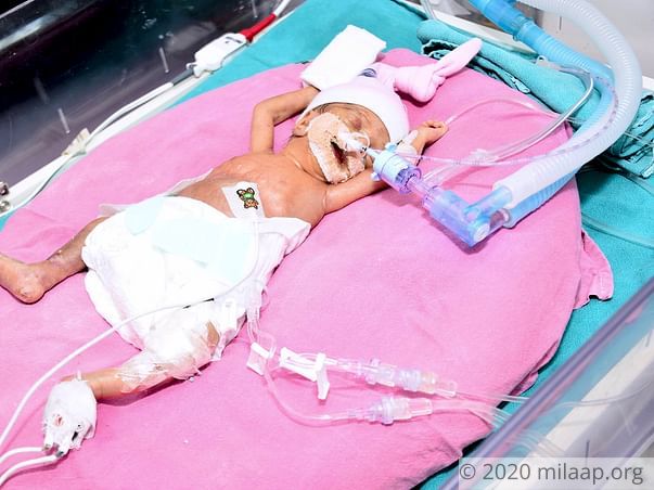 Baby of Santosh needs your help to fight disease