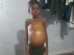 Help Little Arul Undergo Liver Transplant