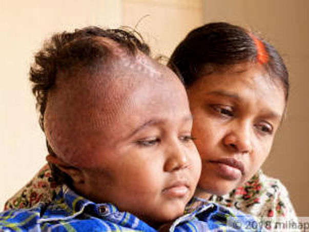 A Deadly Tumor Has Disfigured This Young Boy's Face, Needs Help