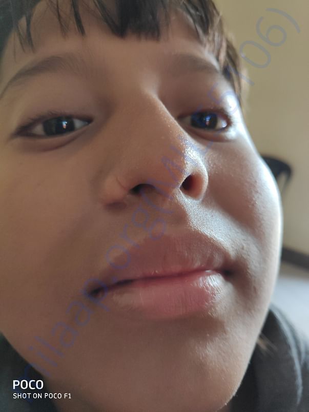 Pic of her nose. Both nostrills sizes are different.