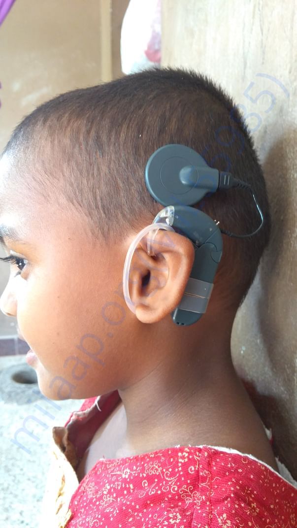 Cochlear Implantation in her left ear