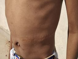 Help Vikas Recover from Thalassemia