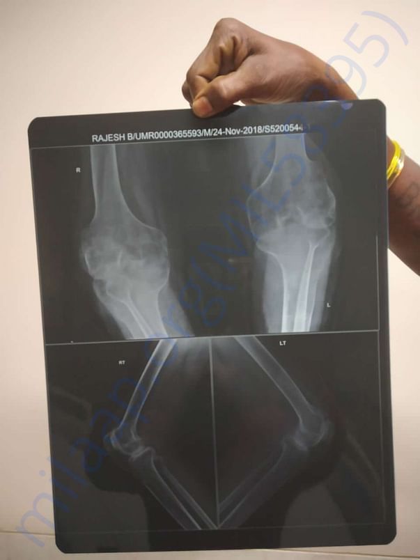 Legs Xray. He was unable to straighten the legs.