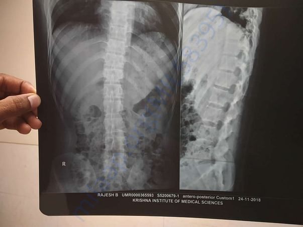Infected Spine and Hip Xray